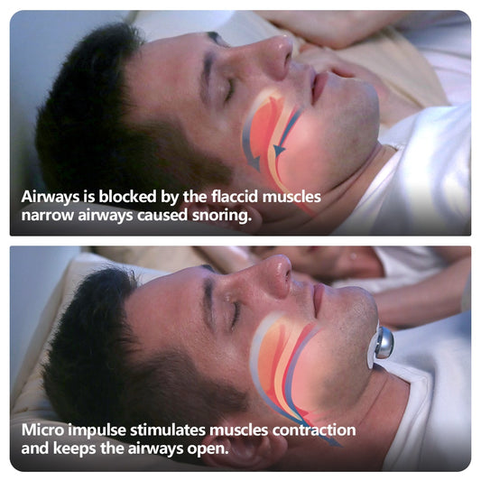 Smart Anti-Snoring Stimulator